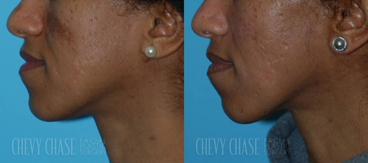 Chemical Peels Before & After Gallery - Patient 106387485 - Image 5