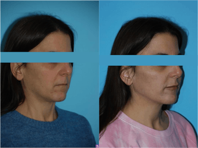 Dermal Fillers Before & After Gallery - Patient 106387489 - Image 1