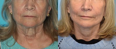 Facelift And Necklift Before & After Gallery - Patient 106387518 - Image 1