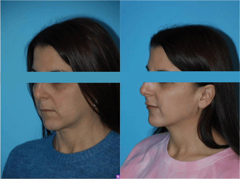 Dermal Fillers Before & After Gallery - Patient 106387489 - Image 2