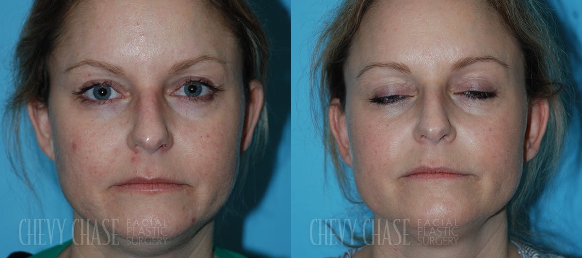 Chemical Peels Before & After Gallery - Patient 106387491 - Image 1