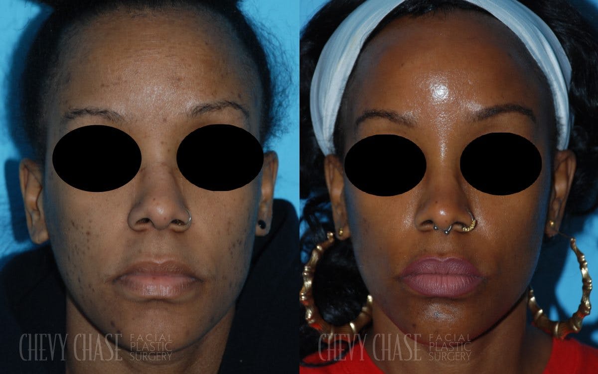 Combination Treatments Before & After Gallery - Patient 106387490 - Image 5