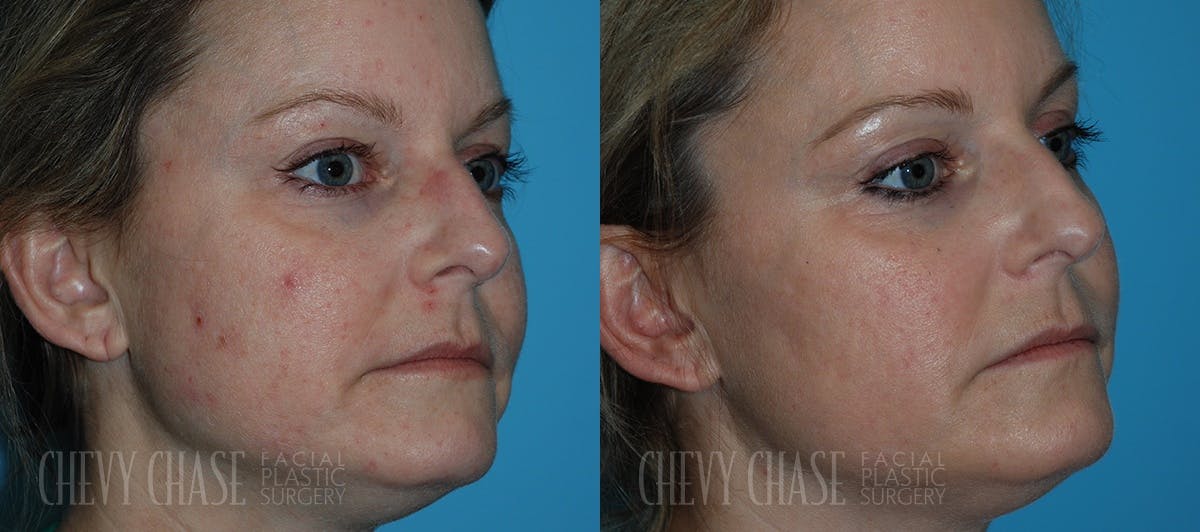 Chemical Peels Before & After Gallery - Patient 106387491 - Image 2