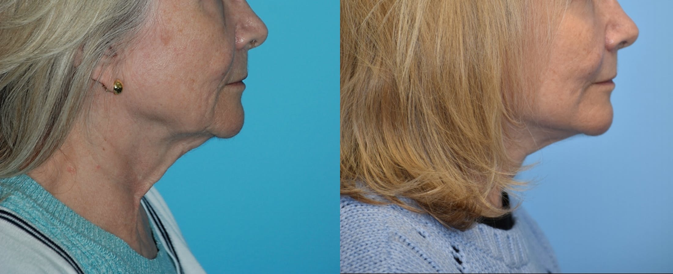 Facelift And Necklift Before & After Gallery - Patient 106387518 - Image 2