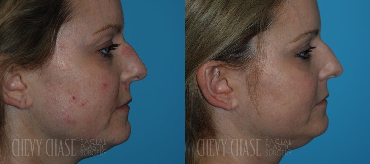 Chemical Peels Before & After Gallery - Patient 106387491 - Image 3