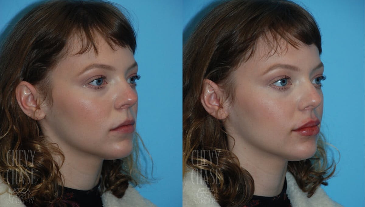 Dermal Fillers Before & After Gallery - Patient 106387493 - Image 2