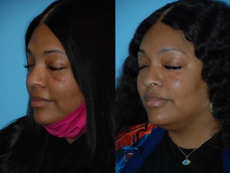 Combination Treatments Before & After Gallery - Patient 106387496 - Image 1