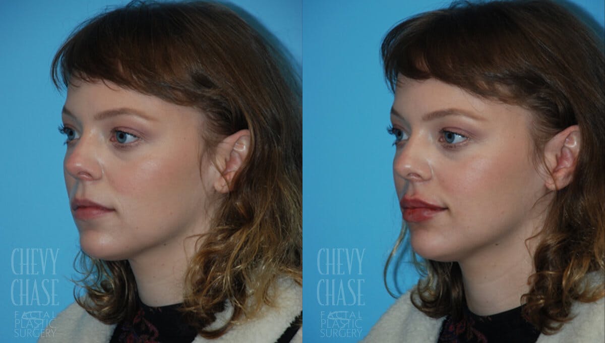 Dermal Fillers Before & After Gallery - Patient 106387493 - Image 3
