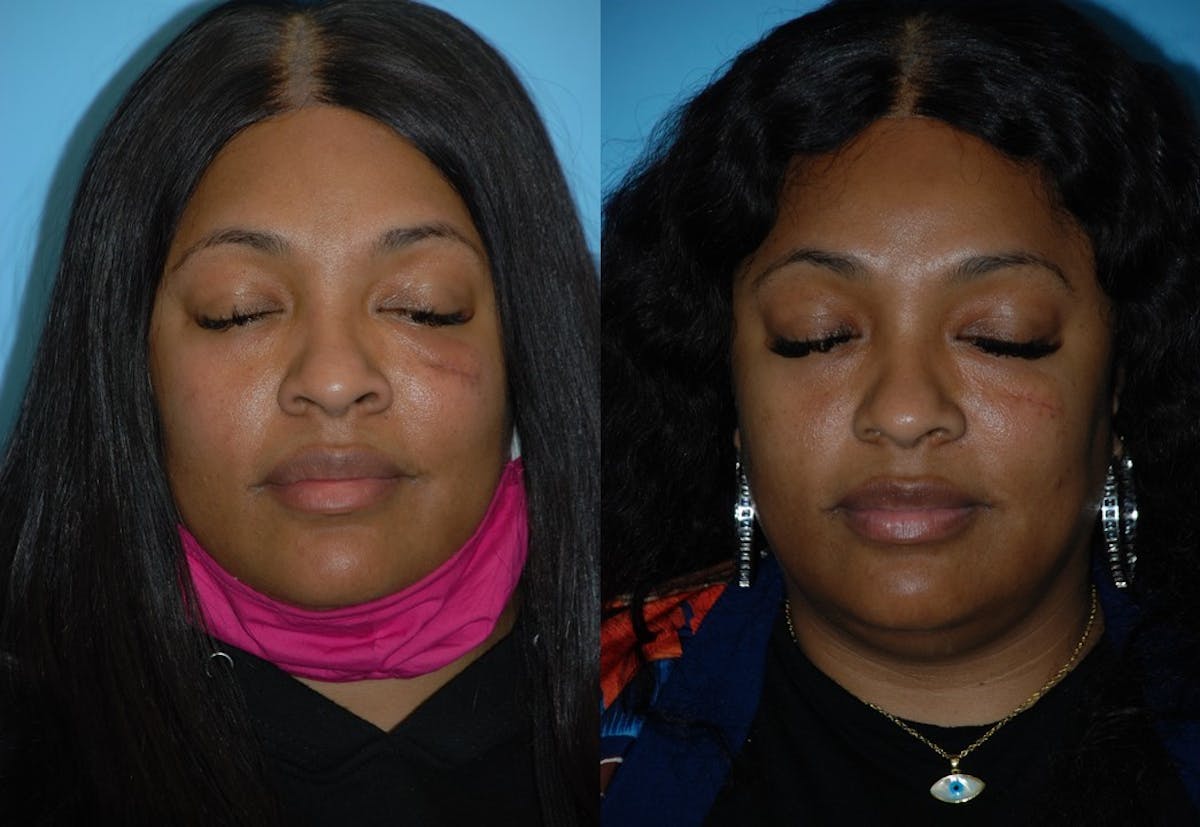 Combination Treatments Before & After Gallery - Patient 106387496 - Image 2
