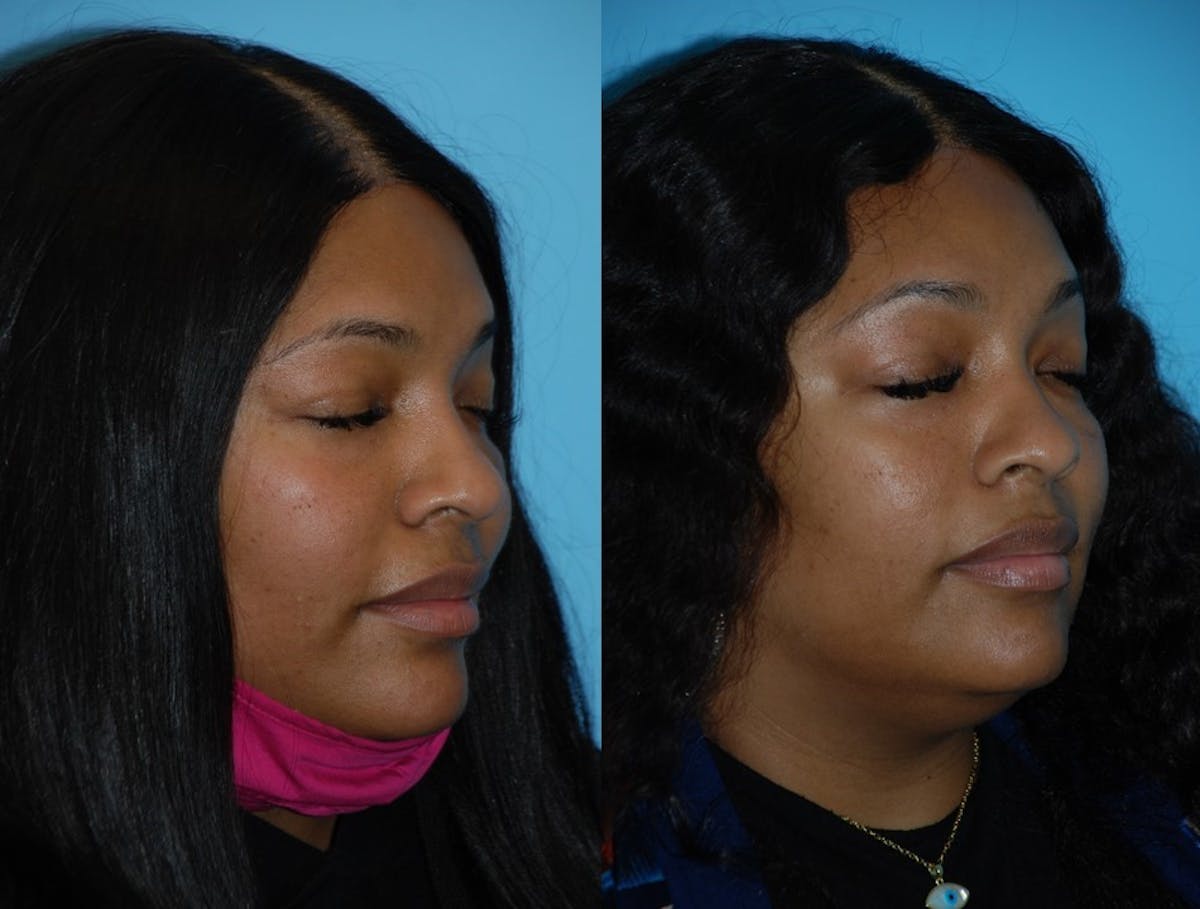 Combination Treatments Before & After Gallery - Patient 106387496 - Image 3