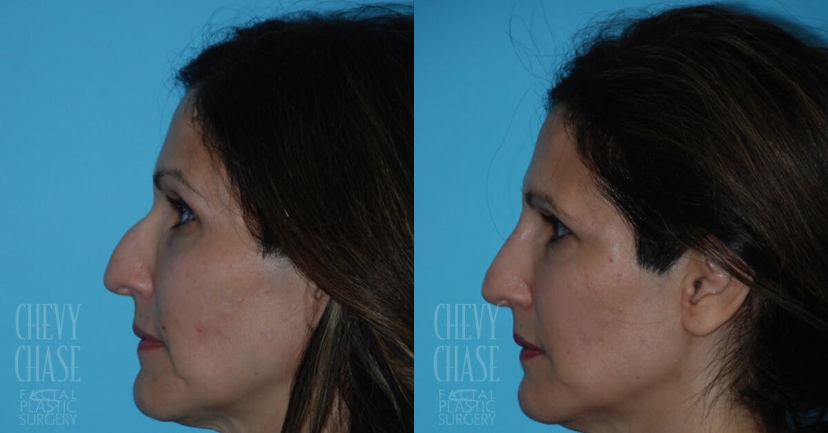 Dermal Fillers Before & After Gallery - Patient 106387498 - Image 1