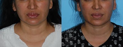Morpheus8 Before & After Gallery - Patient 106387502 - Image 1