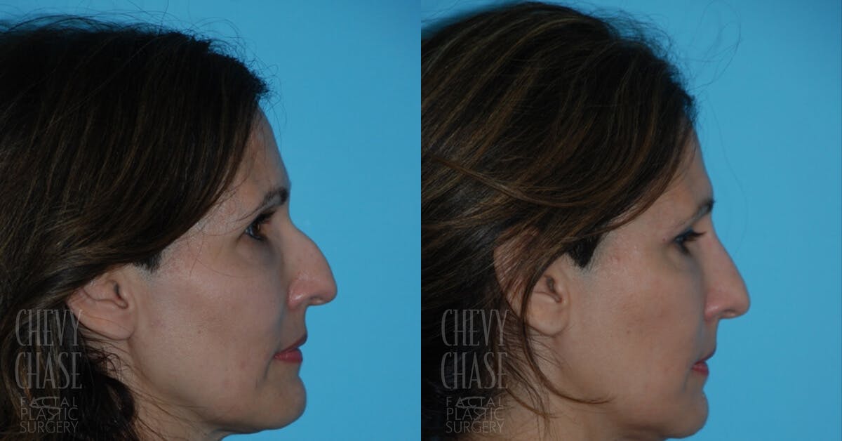 Dermal Fillers Before & After Gallery - Patient 106387498 - Image 2