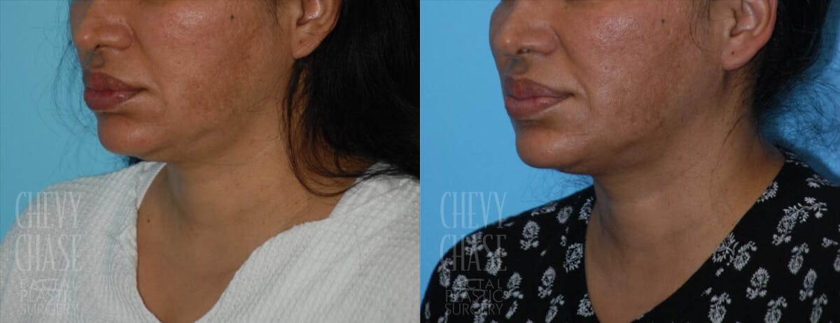 Morpheus8 Before & After Gallery - Patient 106387502 - Image 2