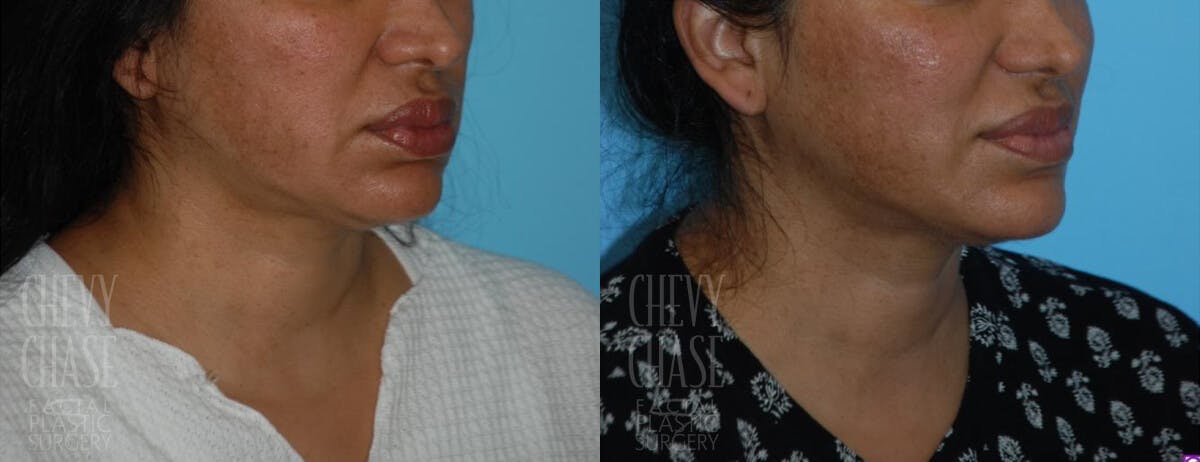 Morpheus8 Before & After Gallery - Patient 106387502 - Image 4