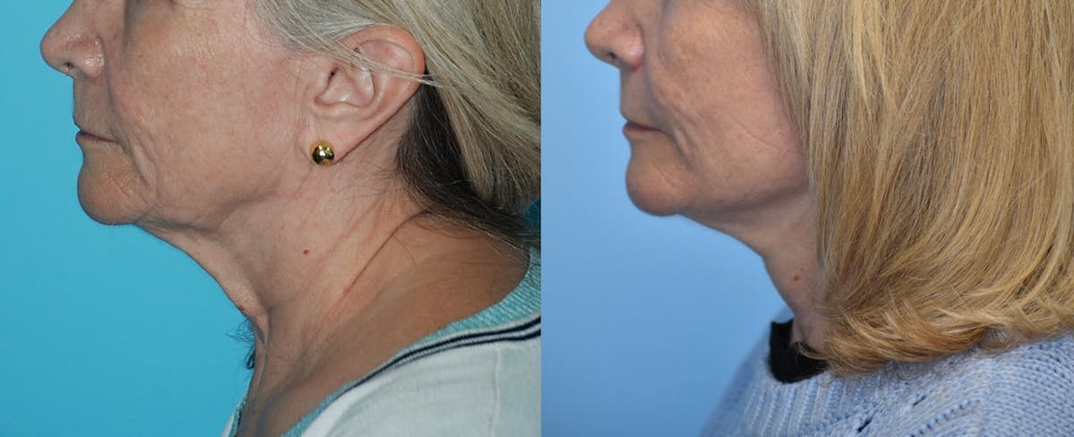 Facelift And Necklift Before & After Gallery - Patient 106387518 - Image 3