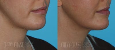 Kybella® Before & After Gallery - Patient 106387512 - Image 1