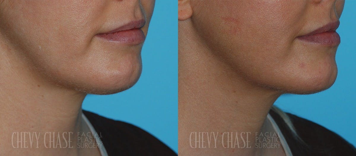 Kybella® Before & After Gallery - Patient 106387512 - Image 1