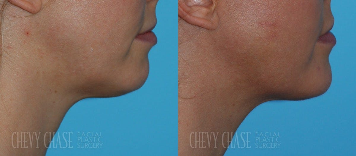 Kybella® Before & After Gallery - Patient 106387512 - Image 2