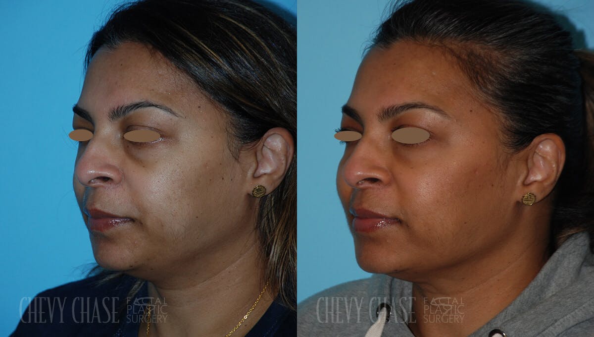 Dermal Fillers Before & After Gallery - Patient 106387514 - Image 3