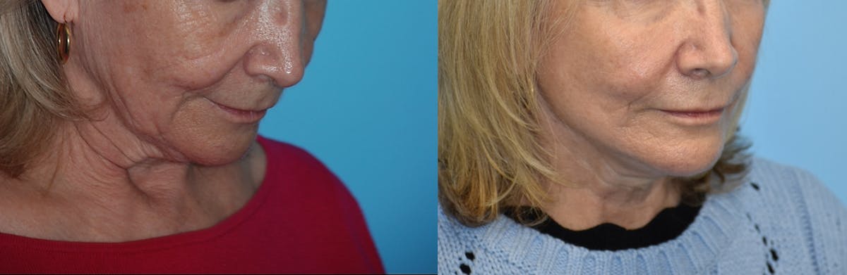 Facelift And Necklift Before & After Gallery - Patient 106387518 - Image 4