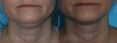 Kybella® Before & After Gallery - Patient 106387515 - Image 1