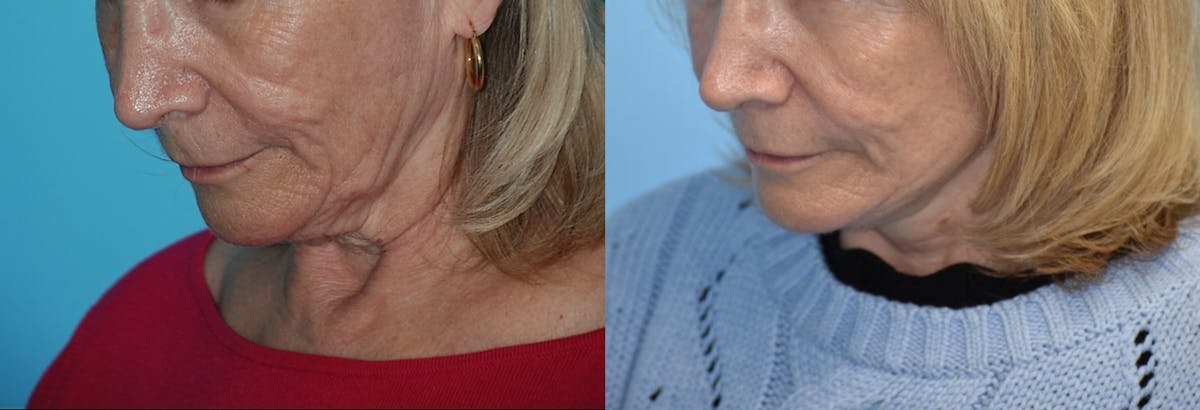 Facelift And Necklift Before & After Gallery - Patient 106387518 - Image 5