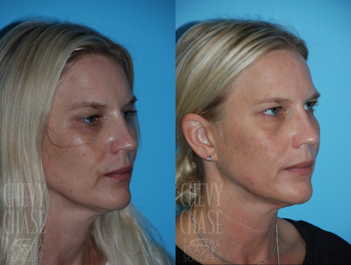 Morpheus8 Before & After Gallery - Patient 106387516 - Image 3