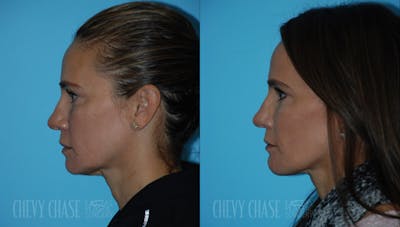 Dermal Fillers Before & After Gallery - Patient 106387519 - Image 1