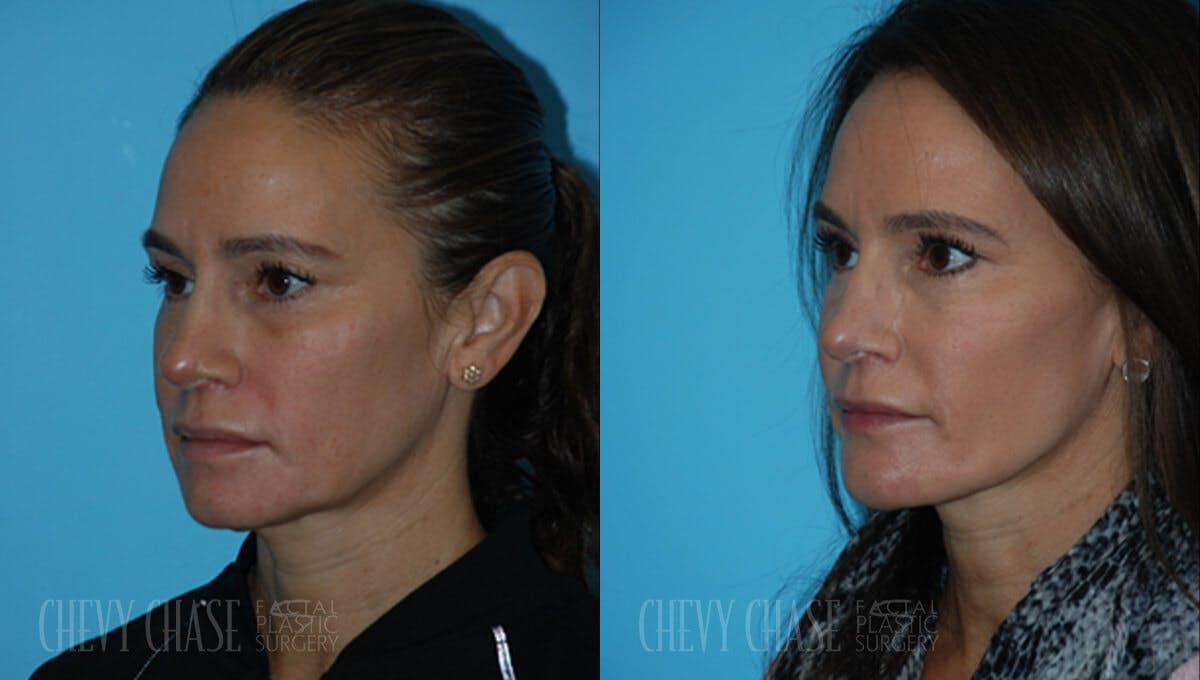 Dermal Fillers Before & After Gallery - Patient 106387519 - Image 2