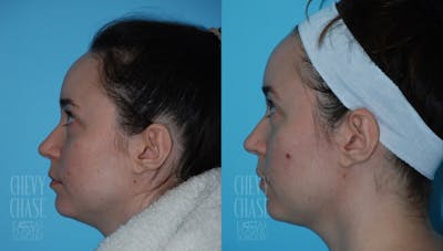 Morpheus8 Before & After Gallery - Patient 106387523 - Image 1