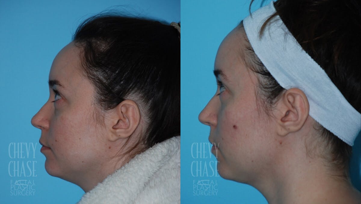Morpheus8 Before & After Gallery - Patient 106387523 - Image 1