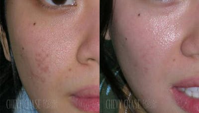 MicroLaserPeel™ Before & After Gallery - Patient 106387521 - Image 1