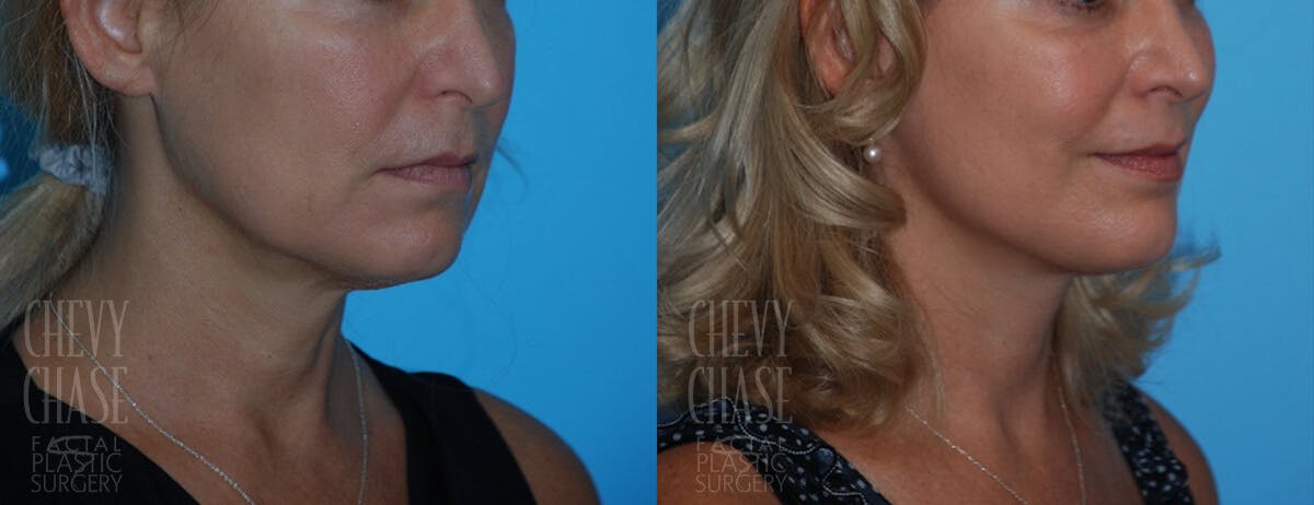 Facelift And Necklift Before & After Gallery - Patient 106387529 - Image 1