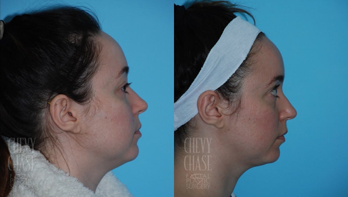 Morpheus8 Before & After Gallery - Patient 106387523 - Image 2