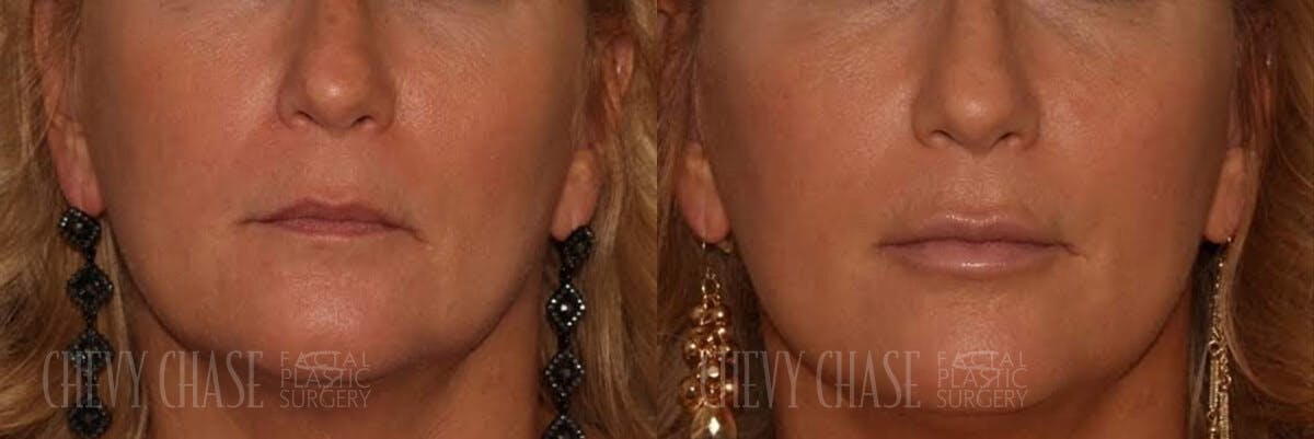 Dermal Fillers Before & After Gallery - Patient 106387522 - Image 1
