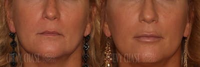 Dermal Fillers Before & After Gallery - Patient 106387522 - Image 1