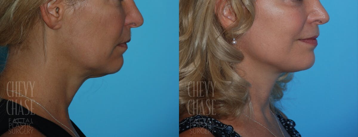 Facelift And Necklift Before & After Gallery - Patient 106387529 - Image 2