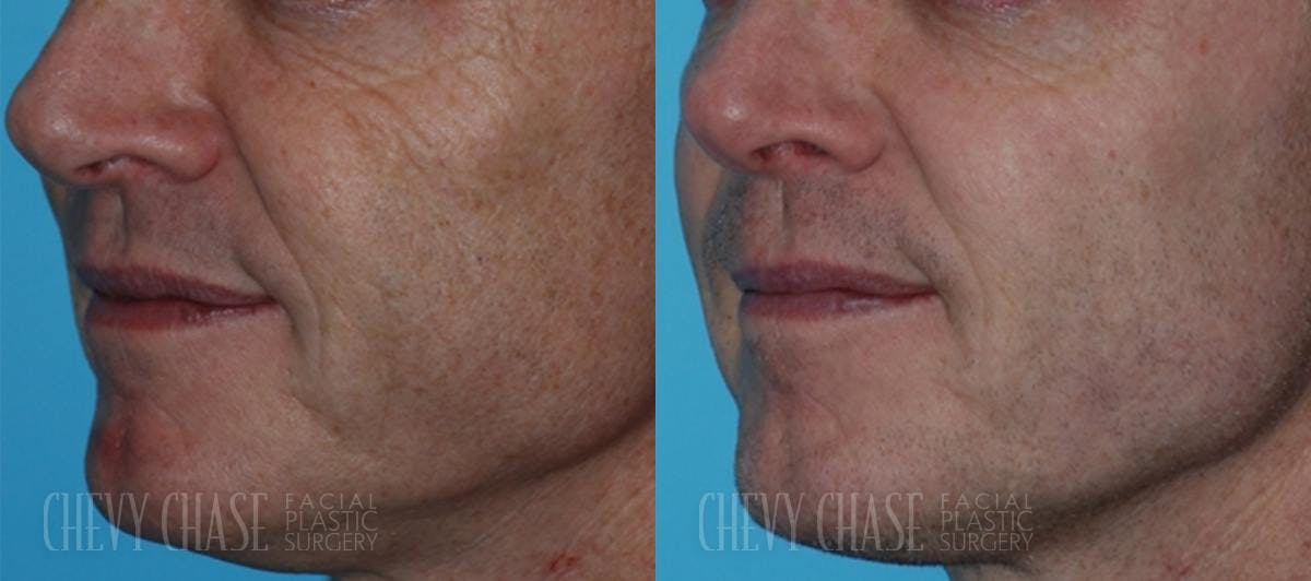 MicroLaserPeel™ Before & After Gallery - Patient 106387524 - Image 1