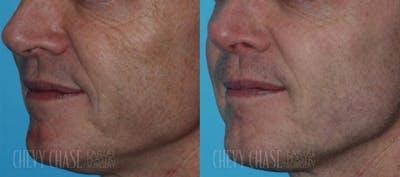 MicroLaserPeel™ Before & After Gallery - Patient 106387524 - Image 1