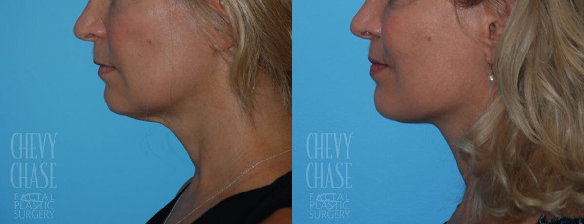 Facelift And Necklift Before & After Gallery - Patient 106387529 - Image 3