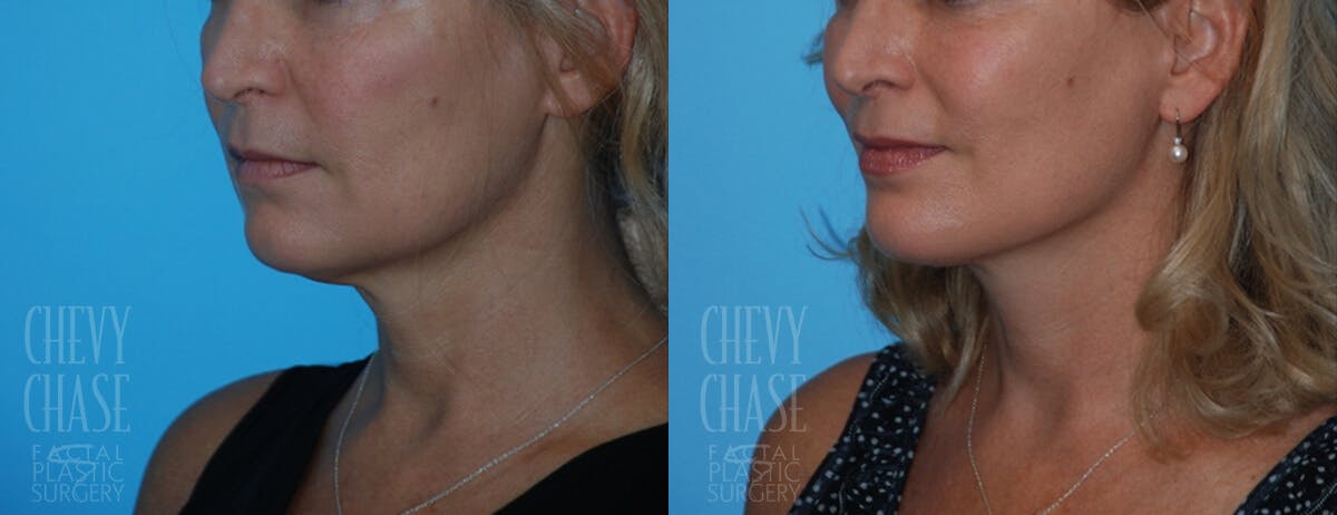 Facelift And Necklift Before & After Gallery - Patient 106387529 - Image 4