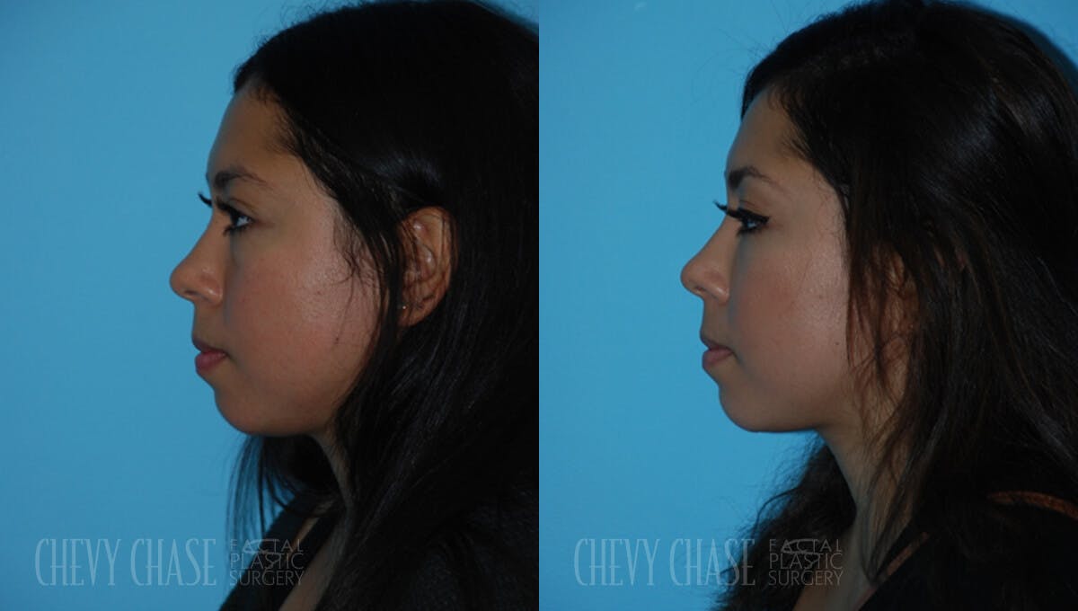 Dermal Fillers Before & After Gallery - Patient 106387532 - Image 1