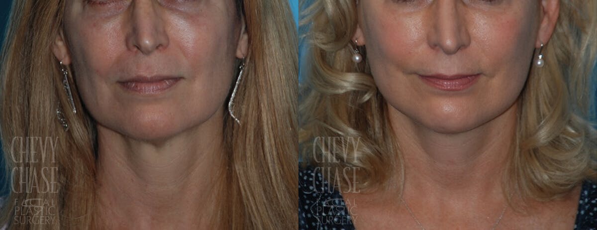 Facelift And Necklift Before & After Gallery - Patient 106387529 - Image 5