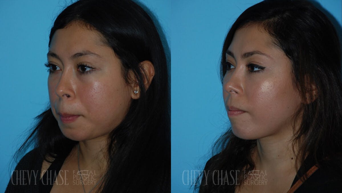 Dermal Fillers Before & After Gallery - Patient 106387532 - Image 2