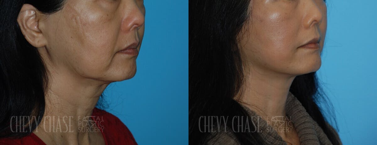 Facelift And Necklift Before & After Gallery - Patient 106387539 - Image 1