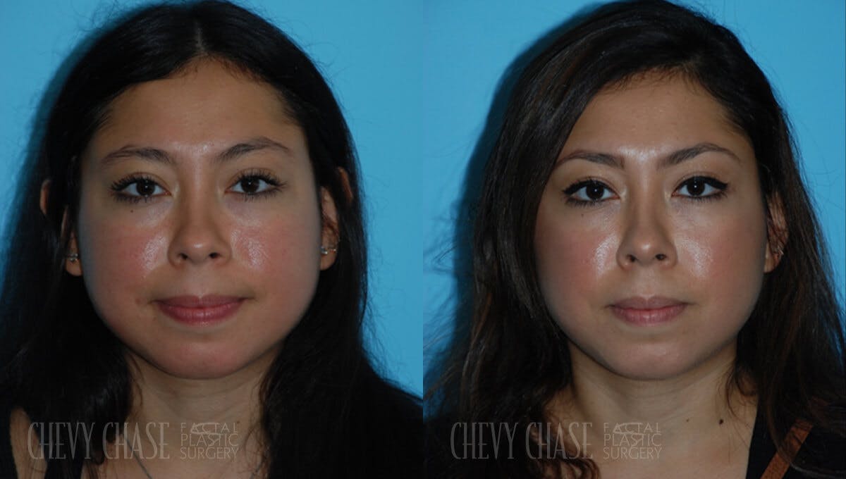 Dermal Fillers Before & After Gallery - Patient 106387532 - Image 3