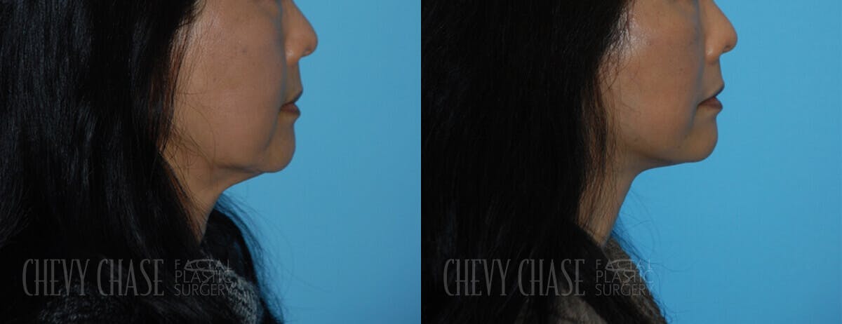 Facelift And Necklift Before & After Gallery - Patient 106387539 - Image 2