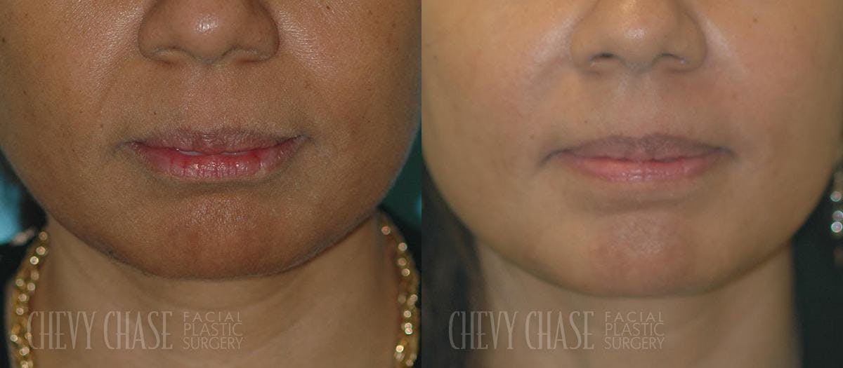 Dermal Fillers Before & After Gallery - Patient 106387534 - Image 1