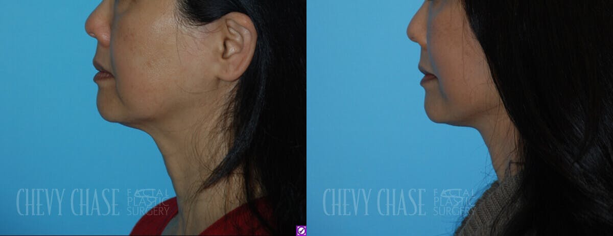 Facelift And Necklift Before & After Gallery - Patient 106387539 - Image 3